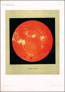 Oeller, Johann: Atlas der Ophthalmoskopie